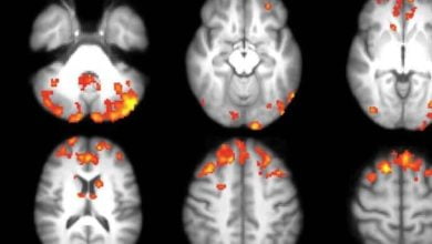 Image scanner sclerose en plaques